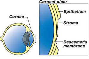 Corneal Ulcers description